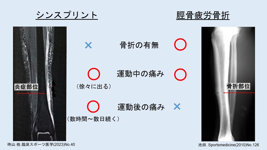 “すね”に多いスポーツ障害とは？のイメージ写真