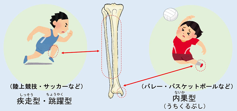 “すね”に生じる疲労骨折とは？のイメージ写真